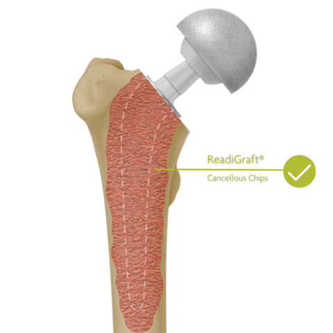 ReadiGraft Cancellous Chips